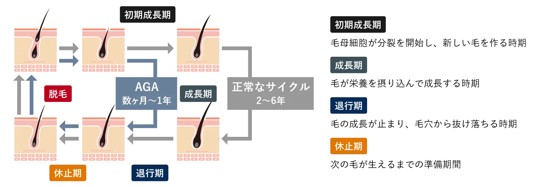 男性型脱毛症（AGA）の原因