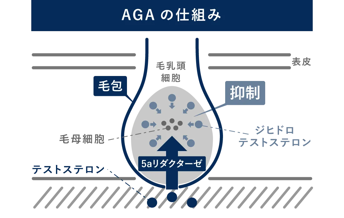 男性型脱毛症（AGA）は遺伝する