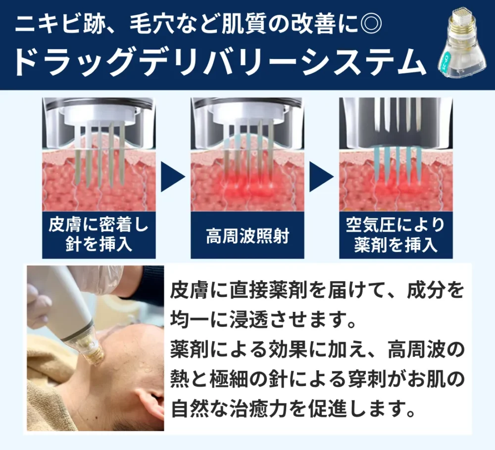 ニキビ跡ボコボコ肌を根本から改善 ポテンツァ